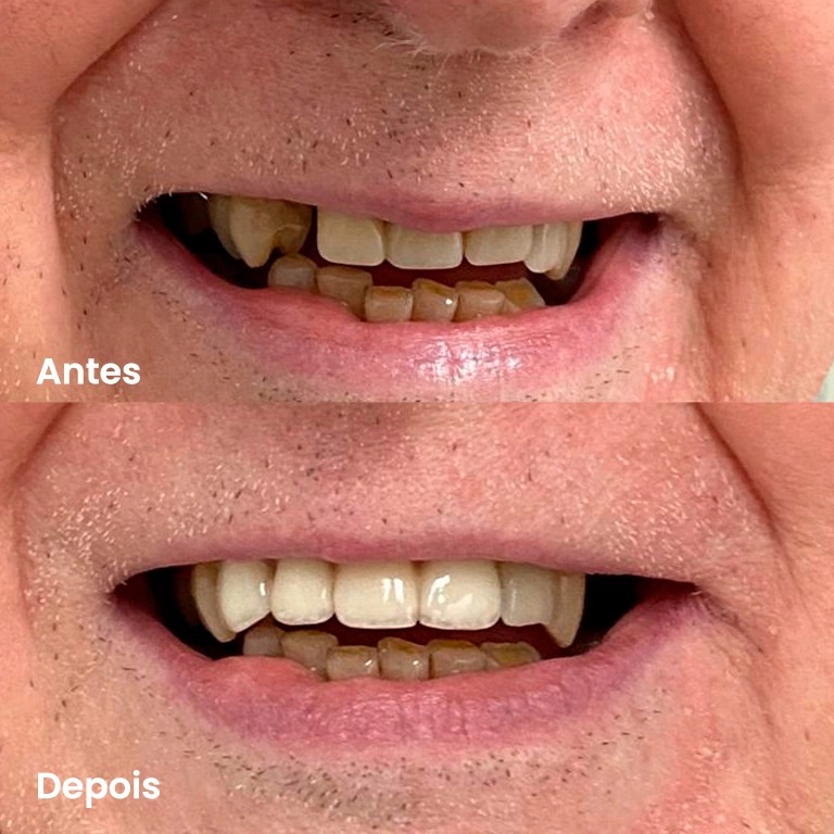 Antes e depois — caso real 1