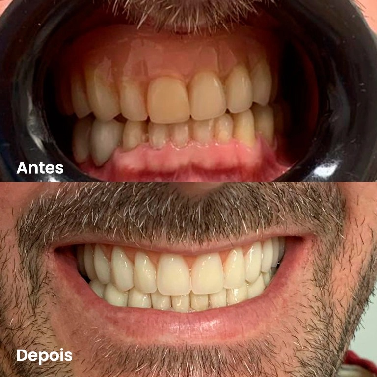 Antes e depois — caso real 2