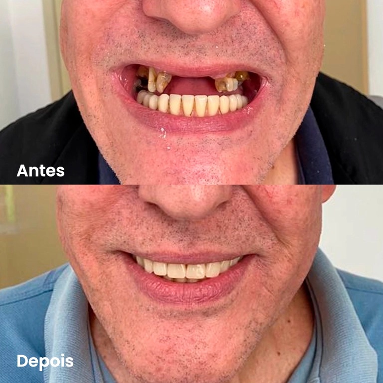 Antes e depois — caso real 4